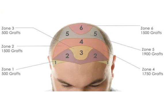 High-Density FUE Doctors in Madipakkam FUE Technique for Beard Transplant
