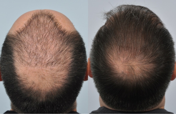 Hair Repair Procedure Steps
