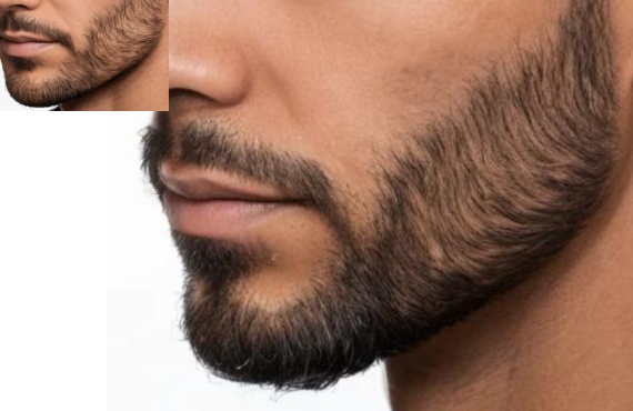 Beard Hair Transplant in Saligramam, Chennai